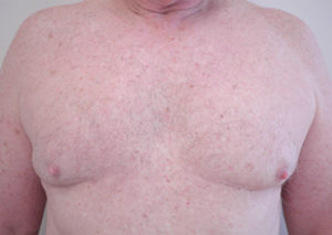 Chest Liposuction For Men