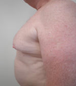 Chest Liposuction For Men