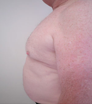 Chest Liposuction For Men