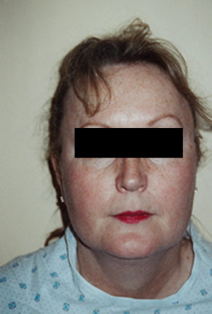 Neck Liposuction