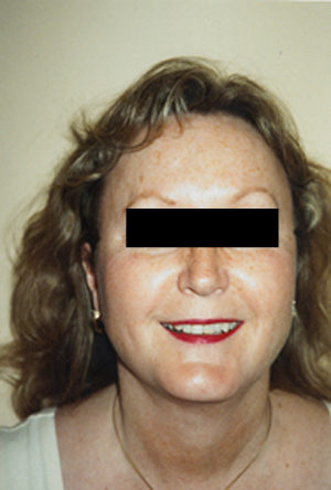 Neck Liposuction