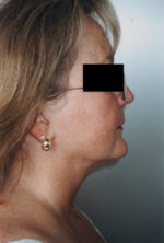 Neck Liposuction