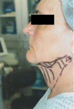 Neck Liposuction