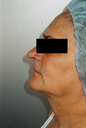 Neck Liposuction