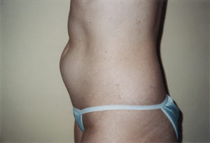 Liposuction of Abdomen