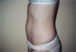 Liposuction of Abdomen