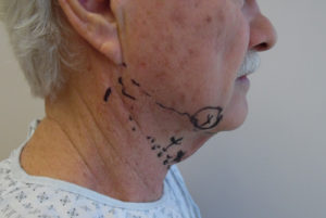 Neck Liposuction For Men