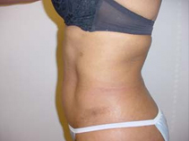 Woman After her abdominoplasty or tummy tuck liposuction surgery.