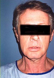 Male Neck Lipo Santa Monica and Los Angeles