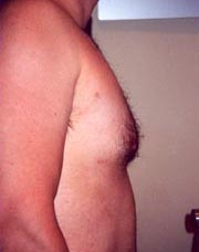Male Liposuction of Chest Result Santa Monica and Los Angeles