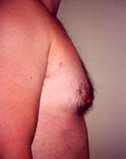 Male Liposuction of Chest Result Santa Monica and Los Angeles