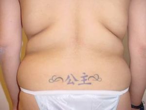 Back Liposuction