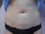 Liposuction of Abdomen