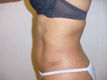Female torso after liposuction with reduced fat