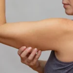 Woman pinching upper arm skin showing excess skin elasticity