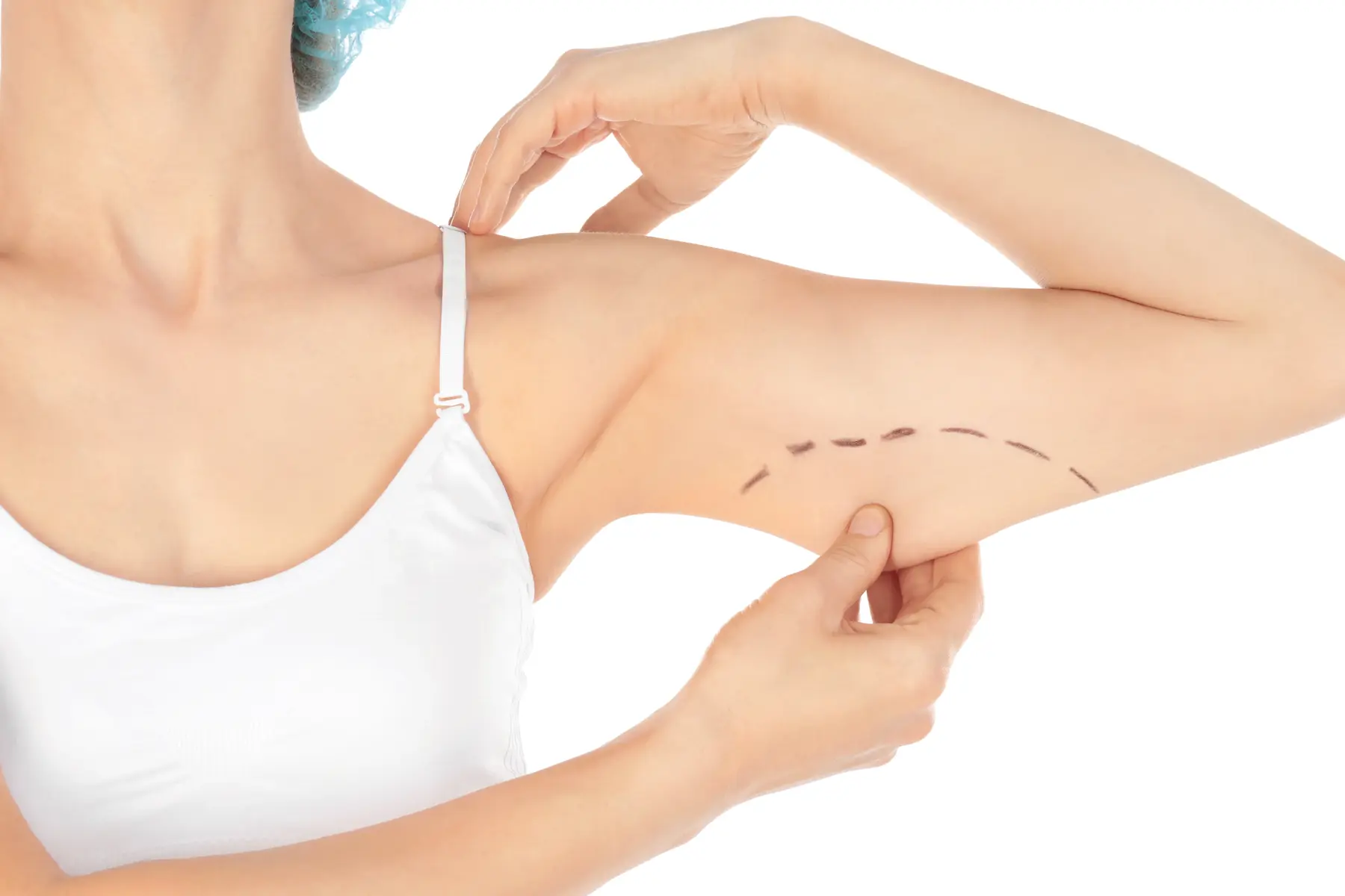 Arm marked for liposuction treatment in Santa Monica