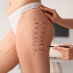 Butt Lipo: Will Fat Removal Make Your Butt Look Flat?