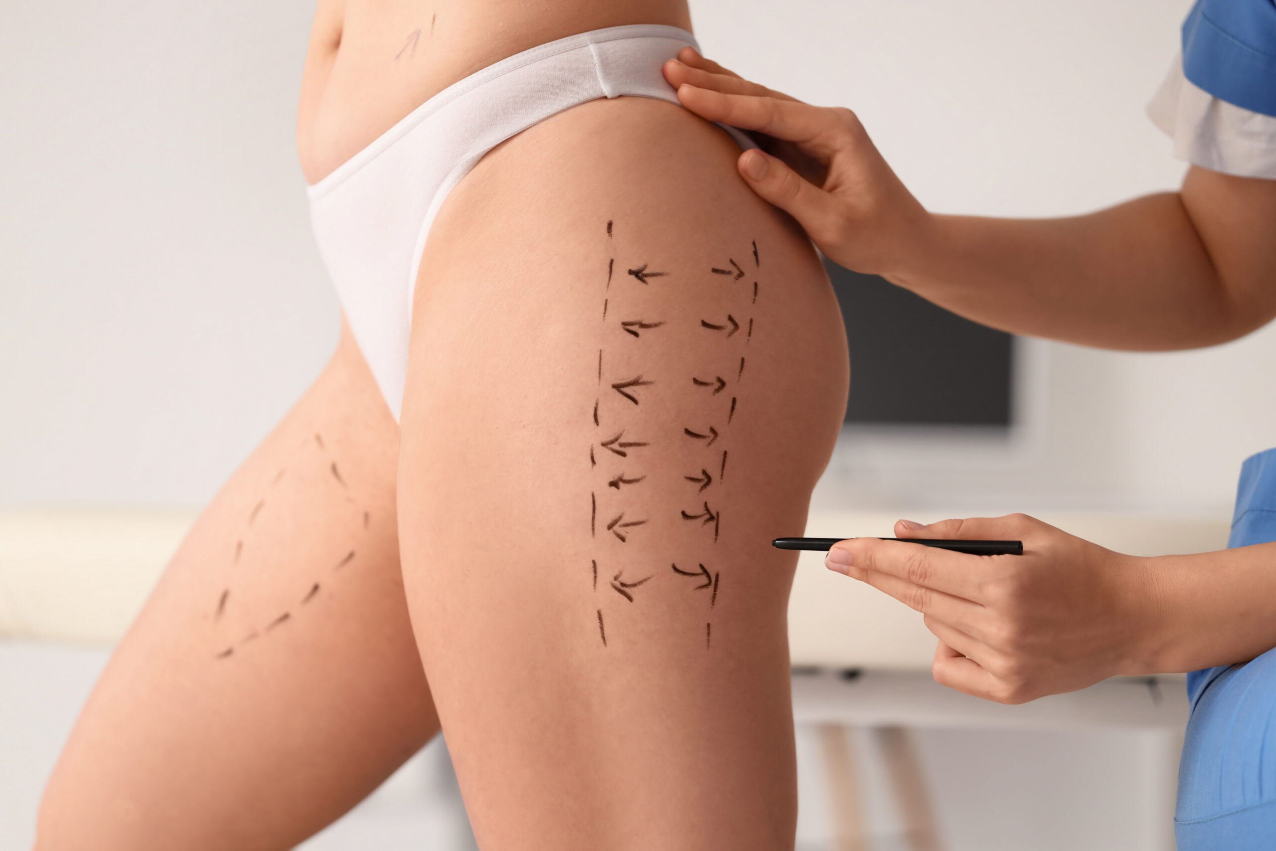 Cosmetic surgeon marking woman thigh and buttocks before body contouring and liposuction procedure in clinic, close up of plastic surgery planning for cellulite and fat reduction Butt Lipo: Will Fat Removal Make Your Butt Look Flat?